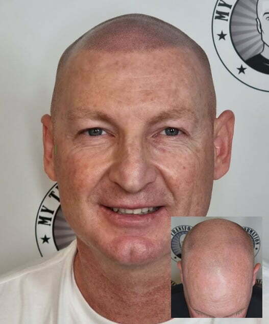 My Transformation, Scalp Micropigmentation Perth, Hair Tattoo Perth, MP Perth, SMP WA, Perth Australia