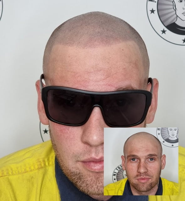 My Transformation, Scalp Micropigmentation Perth, Hair Tattoo Perth, MP Perth, SMP WA, Perth Australia