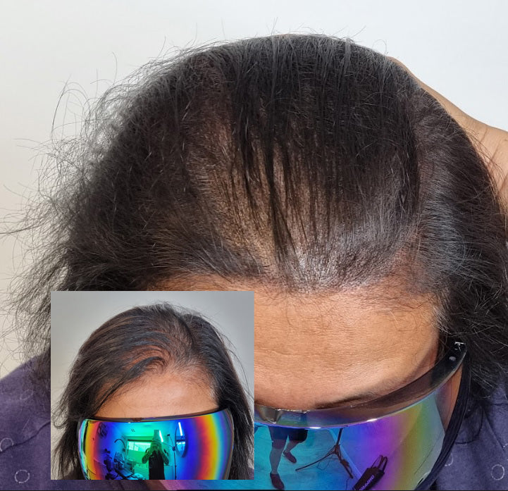 My Transformation, Scalp Micropigmentation Perth, Women's Hair Tattoo Perth, SMP Perth, SMP WA, Perth Australia