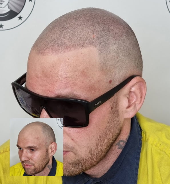 My Transformation, Scalp Micropigmentation Perth, Hair Tattoo Perth, MP Perth, SMP WA, Perth Australia