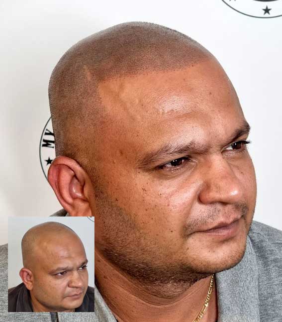 My Transformation, Scalp Micropigmentation Perth, Hair Tattoo Perth, MP Perth, SMP WA, Perth Australia