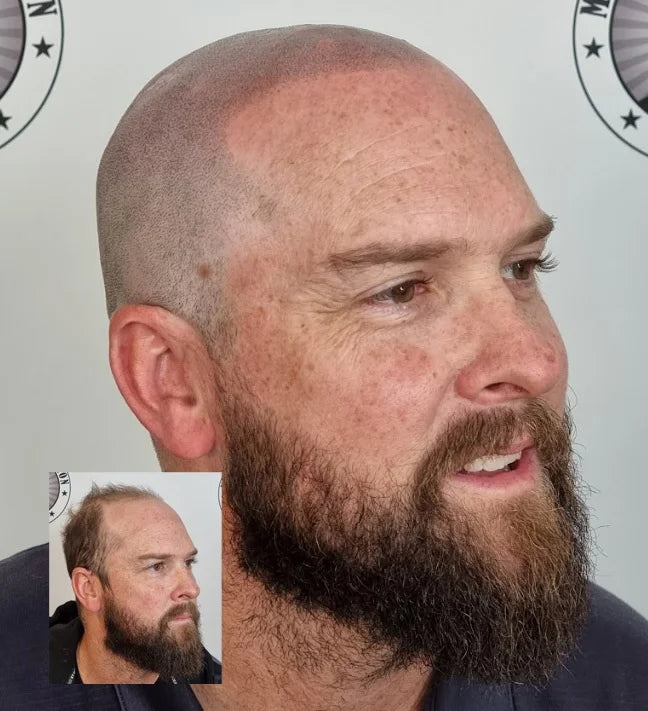 My Transformation, Scalp Micropigmentation Perth, Hair Tattoo Perth, MP Perth, SMP WA, Perth Australia
