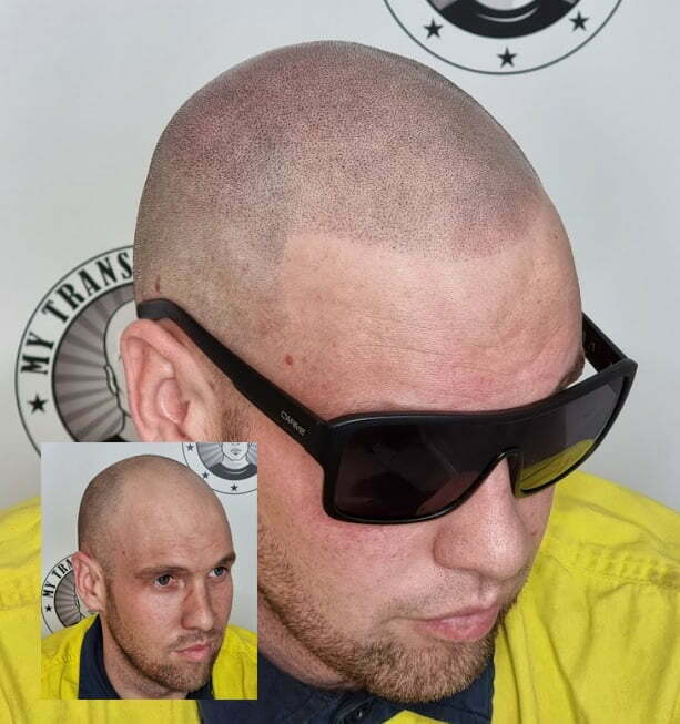 My Transformation, Scalp Micropigmentation Perth, Hair Tattoo Perth, MP Perth, SMP WA, Perth Australia
