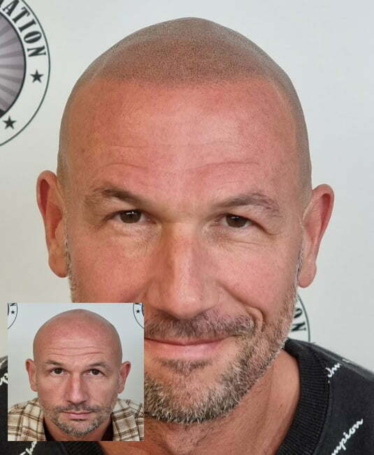 My Transformation, Scalp Micropigmentation Perth, Hair Tattoo Perth, MP Perth, SMP WA, Perth Australia