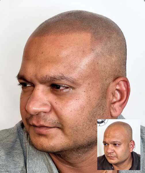 My Transformation, Scalp Micropigmentation Perth, Hair Tattoo Perth, MP Perth, SMP WA, Perth Australia