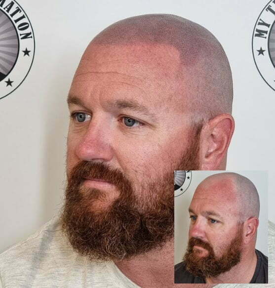 My Transformation, Scalp Micropigmentation Perth, Hair Tattoo Perth, MP Perth, SMP WA, Perth Australia