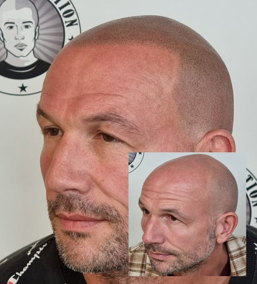 My Transformation, Scalp Micropigmentation Perth, Hair Tattoo Perth, MP Perth, SMP WA, Perth Australia