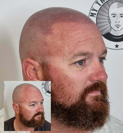 My Transformation, Scalp Micropigmentation Perth, Hair Tattoo Perth, MP Perth, SMP WA, Perth Australia