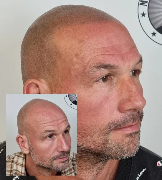 My Transformation, Scalp Micropigmentation Perth, Hair Tattoo Perth, MP Perth, SMP WA, Perth Australia