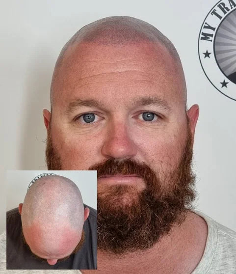 My Transformation, Scalp Micropigmentation Perth, Hair Tattoo Perth, MP Perth, SMP WA, Perth Australia