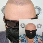 My Transformation, Scalp Micropigmentation Perth, Hair Tattoo Perth, SMP Perth, SMP WA, Perth Australia