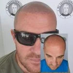 My Transformation, Scalp Micropigmentation Perth, Hair Tattoo Perth, SMP Perth, SMP WA, Perth Australia