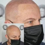 My Transformation, Scalp Micropigmentation Perth, Hair Tattoo Perth, SMP Perth, SMP WA, Perth Australia