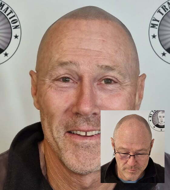 My Transformation, Scalp Micropigmentation Perth, Hair Tattoo Perth, MP Perth, SMP WA, Perth Australia