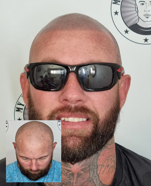 My Transformation, Scalp Micropigmentation Perth, Hair Tattoo Perth, MP Perth, SMP WA, Perth Australia