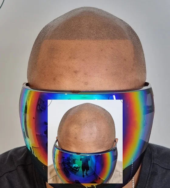 My Transformation, Scalp Micropigmentation Perth, Hair Tattoo Perth, MP Perth, SMP WA, Perth Australia