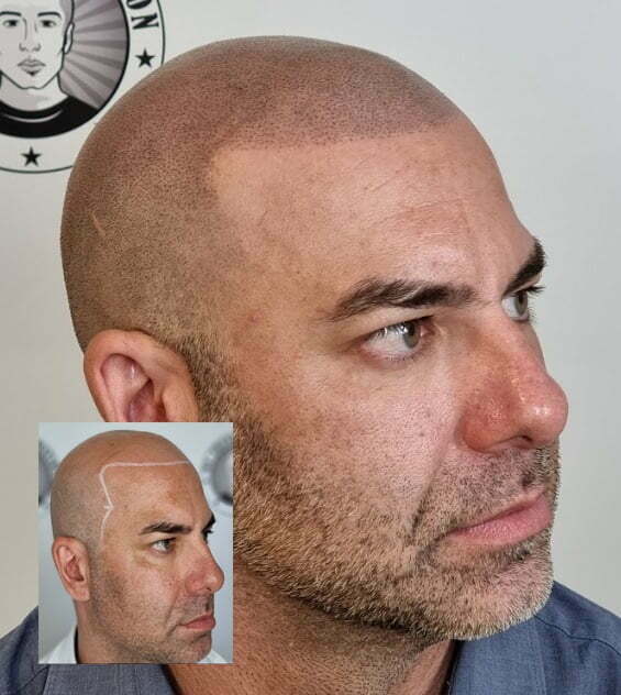 My Transformation, Scalp Micropigmentation Perth, Hair Tattoo Perth, MP Perth, SMP WA, Perth Australia