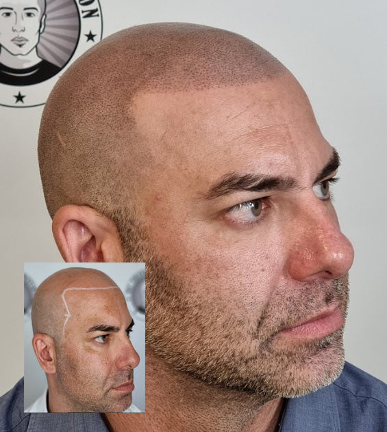 My Transformation, Scalp Micropigmentation Perth, Hair Tattoo Perth, MP Perth, SMP WA, Perth Australia