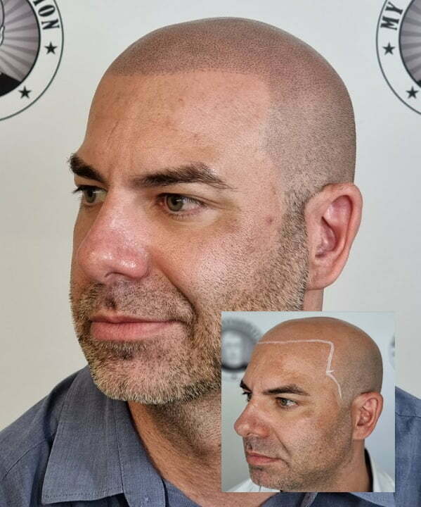 My Transformation, Scalp Micropigmentation Perth, Hair Tattoo Perth, MP Perth, SMP WA, Perth Australia