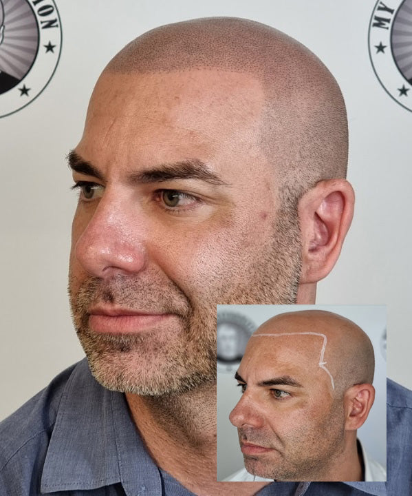 My Transformation, Scalp Micropigmentation Perth, Hair Tattoo Perth, MP Perth, SMP WA, Perth Australia