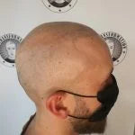 My Transformation, Scalp Micropigmentation Perth, Hair Tattoo Perth, SMP Perth, SMP WA, Perth Australia