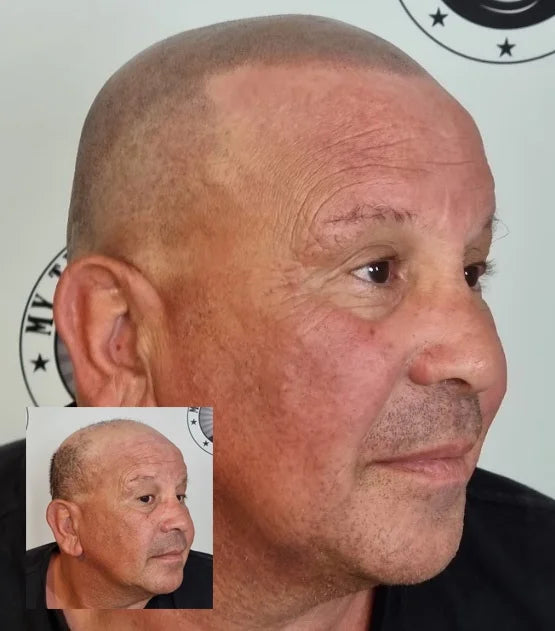 My Transformation, Scalp Micropigmentation Perth, Hair Tattoo Perth, MP Perth, SMP WA, Perth Australia