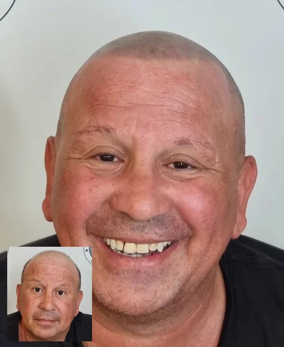 My Transformation, Scalp Micropigmentation Perth, Hair Tattoo Perth, MP Perth, SMP WA, Perth Australia