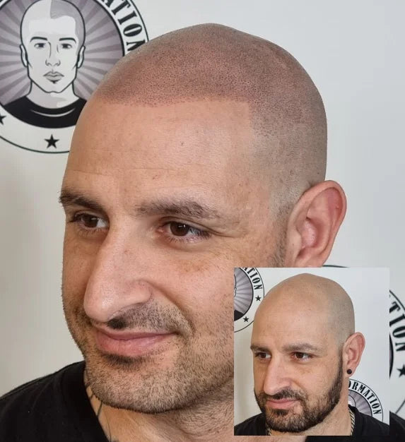 My Transformation, Scalp Micropigmentation Perth, Hair Tattoo Perth, MP Perth, SMP WA, Perth Australia