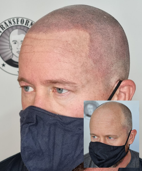 My Transformation, Scalp Micropigmentation Perth, Hair Tattoo Perth, MP Perth, SMP WA, Perth Australia
