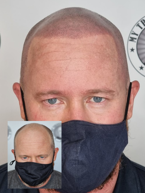 My Transformation, Scalp Micropigmentation Perth, Hair Tattoo Perth, MP Perth, SMP WA, Perth Australia