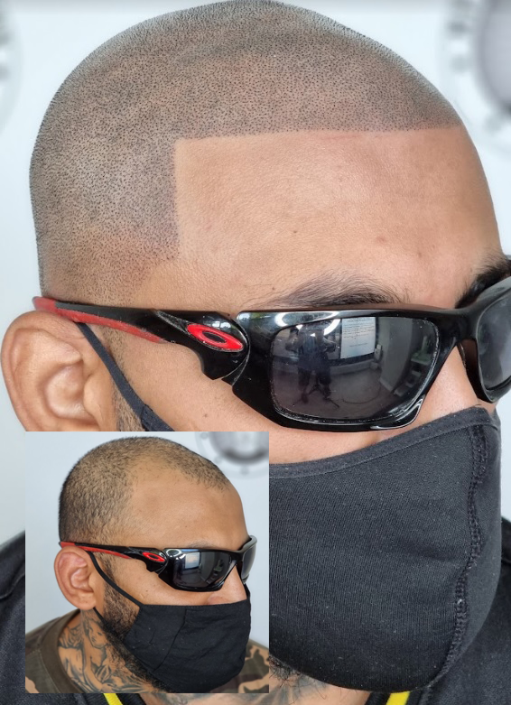 My Transformation, Scalp Micropigmentation Perth, Hair Tattoo Perth, SMP Perth, SMP WA, Perth Australia