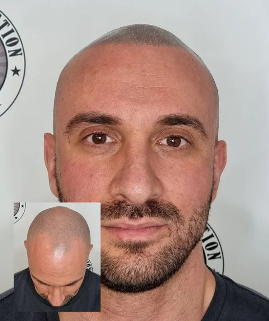 My Transformation, Scalp Micropigmentation Perth, Hair Tattoo Perth, MP Perth, SMP WA, Perth Australia