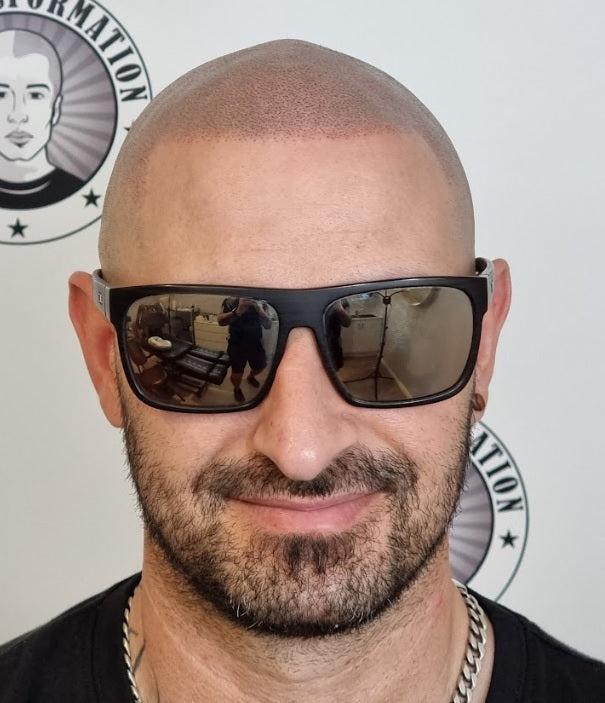 My Transformation, Scalp Micropigmentation Perth, Hair Tattoo Perth, MP Perth, SMP WA, Perth Australia