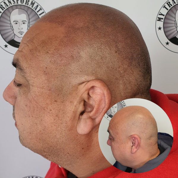 My Transformation, Scalp Micropigmentation Perth, Hair Tattoo Perth, MP Perth, SMP WA, Perth Australia