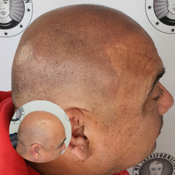 My Transformation, Scalp Micropigmentation Perth, Hair Tattoo Perth, MP Perth, SMP WA, Perth Australia