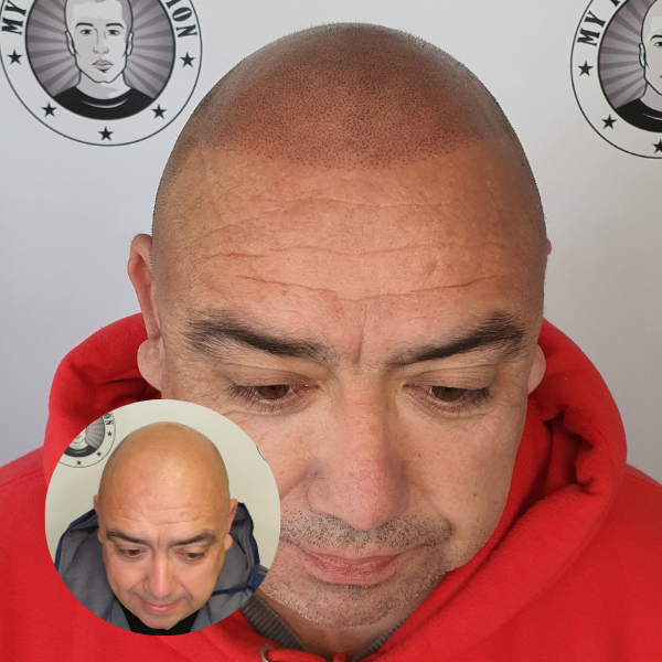 My Transformation, Scalp Micropigmentation Perth, Hair Tattoo Perth, MP Perth, SMP WA, Perth Australia