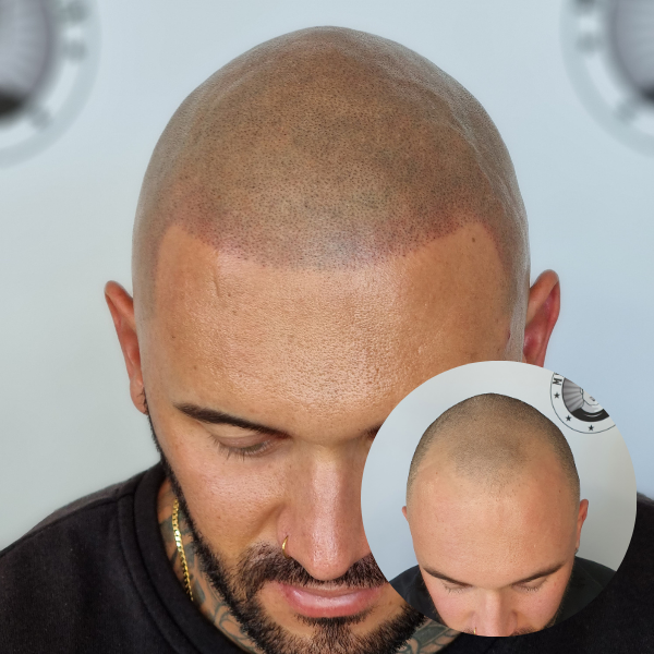 My Transformation, Scalp Micropigmentation Perth, Hair Tattoo Perth, MP Perth, SMP WA, Perth Australia