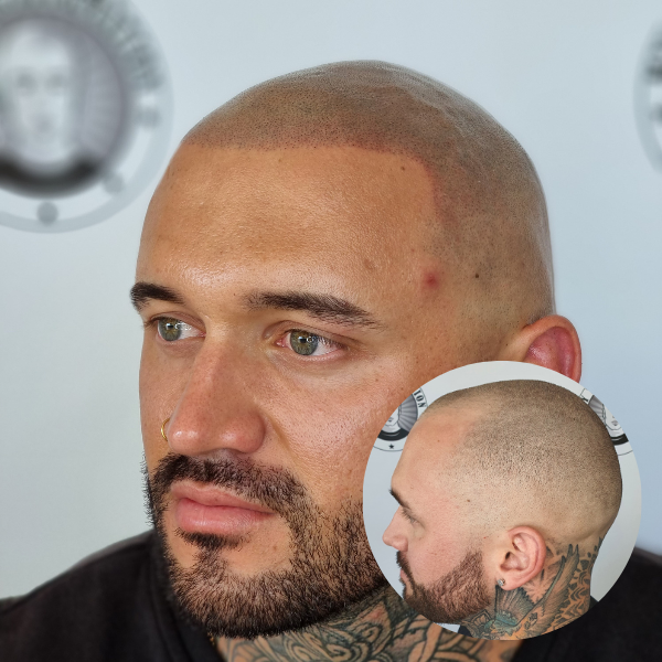 My Transformation, Scalp Micropigmentation Perth, Hair Tattoo Perth, MP Perth, SMP WA, Perth Australia