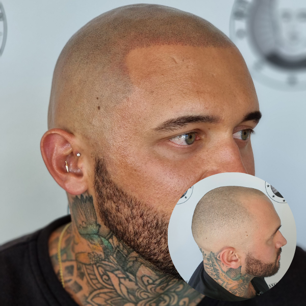 My Transformation, Scalp Micropigmentation Perth, Hair Tattoo Perth, MP Perth, SMP WA, Perth Australia