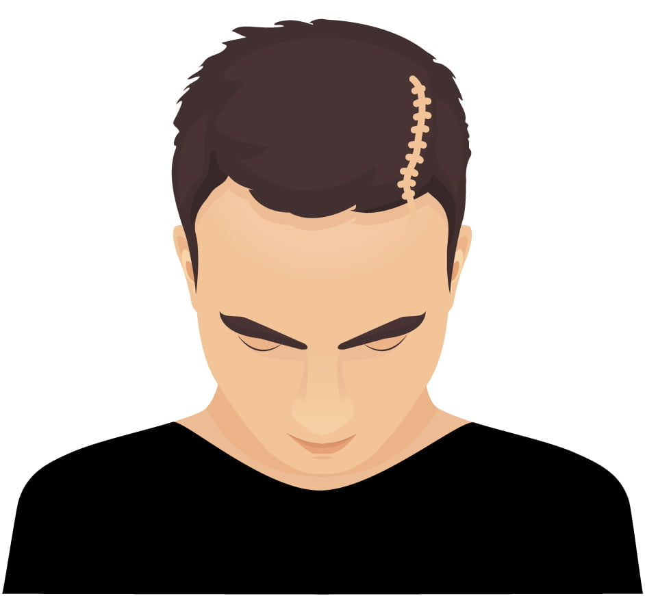 Scalp Micropigmentation (SMP| Hair Tattoo for scars on men & Women. Perth, WA Australia