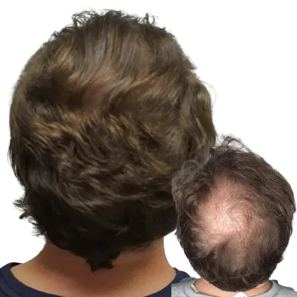 Hair Tattoo for men with thinning hair - SMP can really enhance the look of fuller, thicker hair when your hair is thinning. While a lot of guys don’t mind the buzz cut look, some of you may want to keep your hair long. This all comes down to your current hair loss situation. The goal of scalp micropigmentation with long hair is to conceal the thinning areas and bring back that full, thick head of hair. Perth, Wa Australia