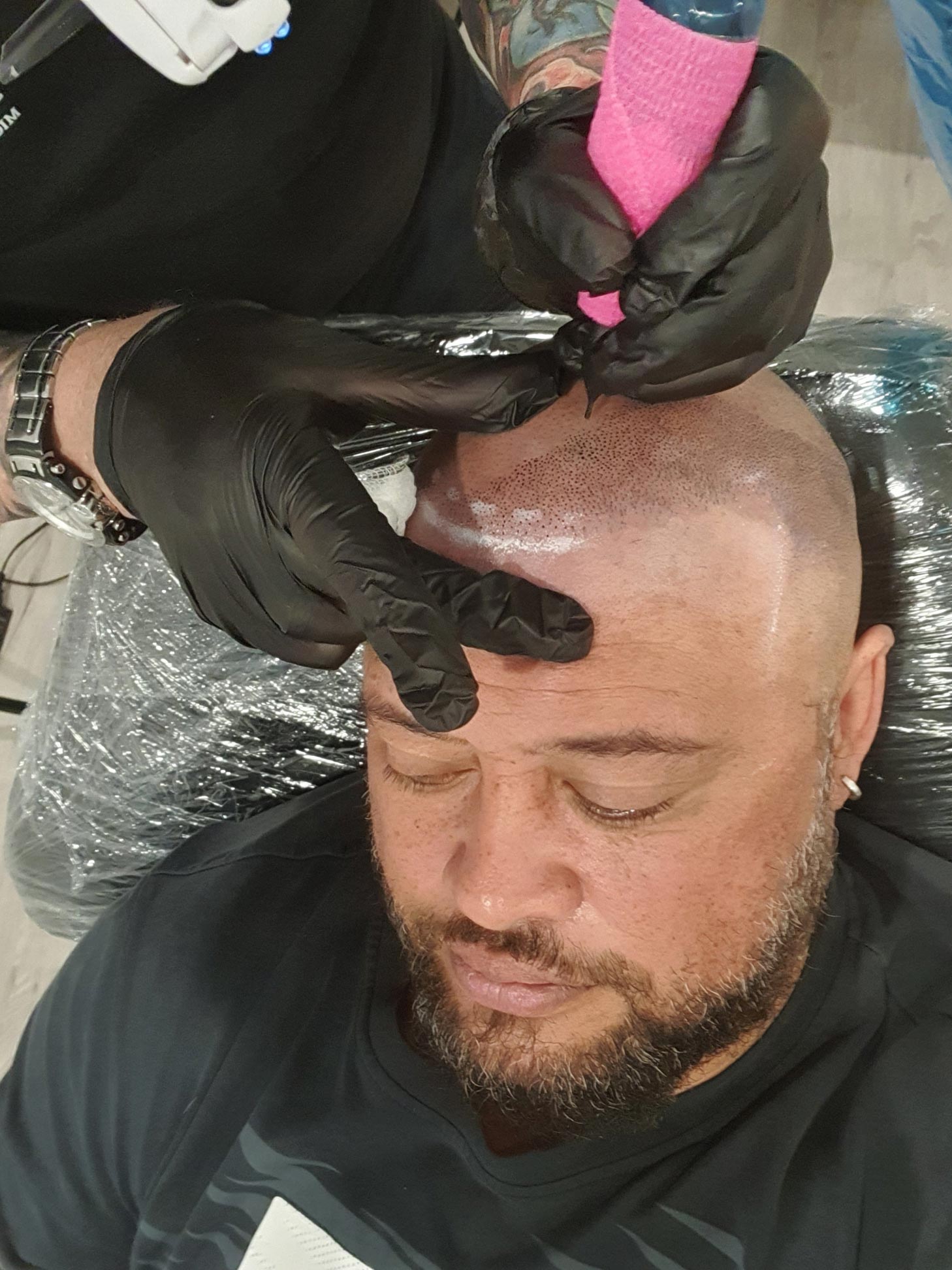 scalp micropigmentation in action