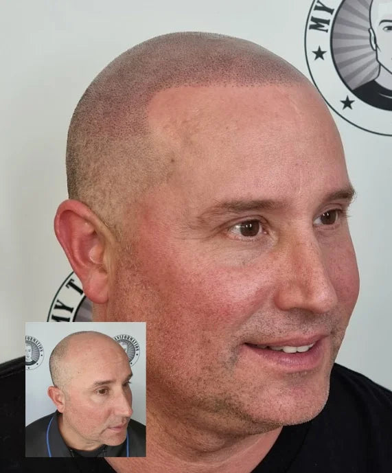 My Transformation, Scalp Micropigmentation Perth, Hair Tattoo Perth, MP Perth, SMP WA, Perth Australia