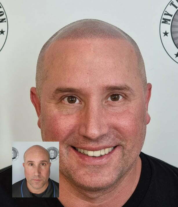 My Transformation, Scalp Micropigmentation Perth, Hair Tattoo Perth, MP Perth, SMP WA, Perth Australia
