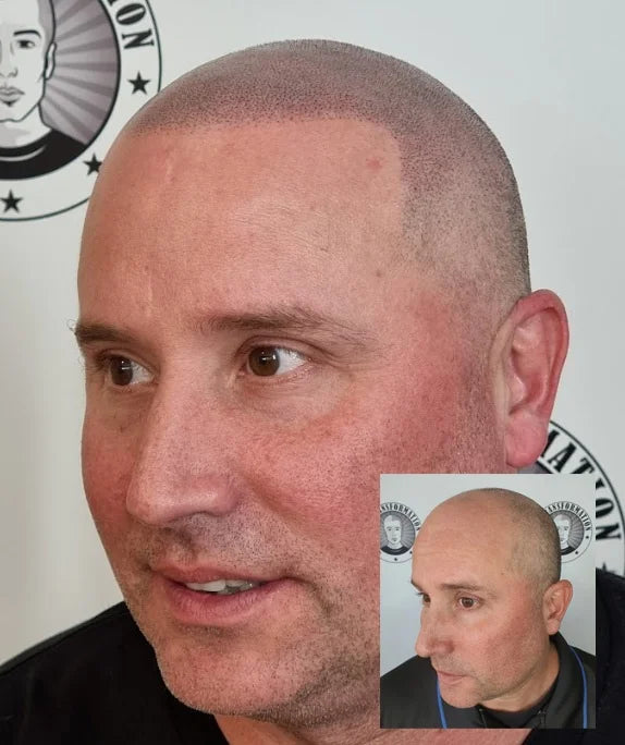 My Transformation, Scalp Micropigmentation Perth, Hair Tattoo Perth, MP Perth, SMP WA, Perth Australia