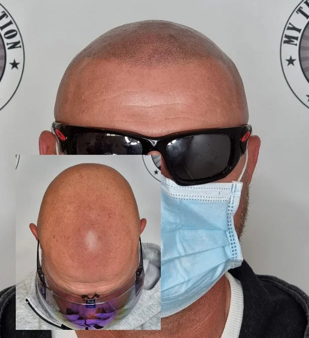 My Transformation, Scalp Micropigmentation Perth, Hair Tattoo Perth, MP Perth, SMP WA, Perth Australia