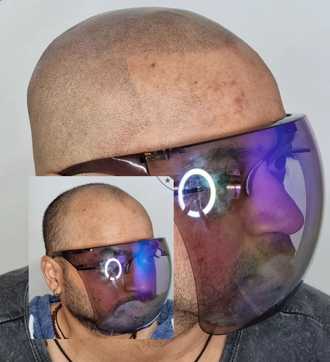 My Transformation, Scalp Micropigmentation Perth, Hair Tattoo Perth, MP Perth, SMP WA, Perth Australia