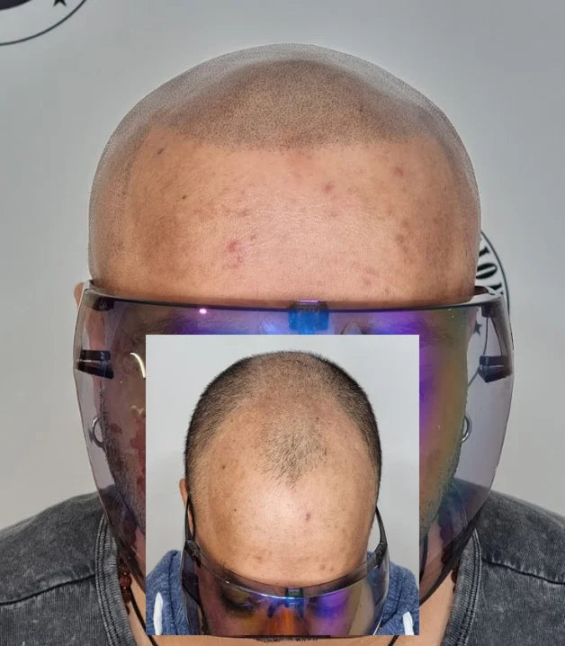 My Transformation, Scalp Micropigmentation Perth, Hair Tattoo Perth, MP Perth, SMP WA, Perth Australia