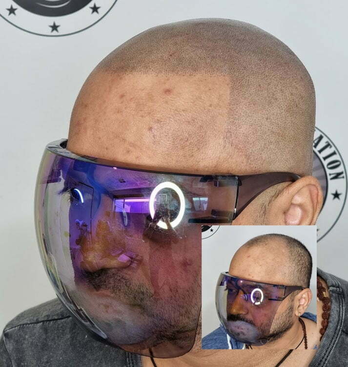 My Transformation, Scalp Micropigmentation Perth, Hair Tattoo Perth, MP Perth, SMP WA, Perth Australia