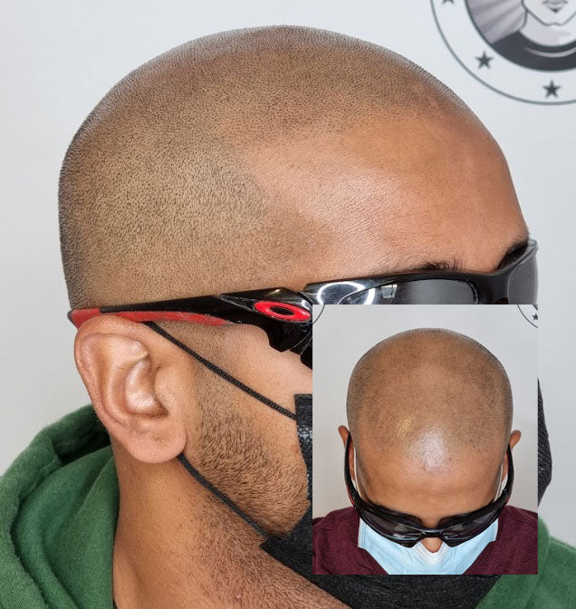 My Transformation, Scalp Micropigmentation Perth, Hair Tattoo Perth, SMP Perth, SMP WA, Perth Australia